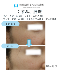 症例3　くすみ、肝班