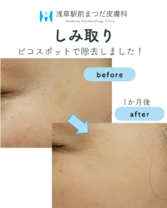 症例1　しみ取り