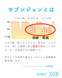 サブシジョンとは