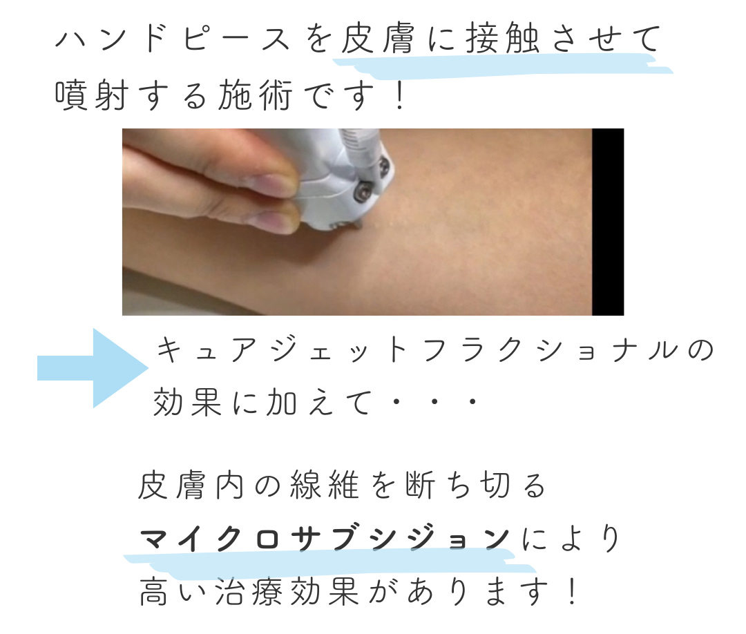 キュアジェットコンタクト