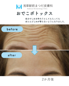 しわ改善注射の症例