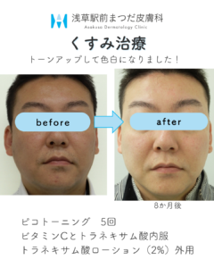 症例2　くすみ治療