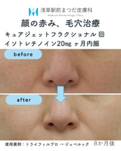 症例5 顔の赤み、毛穴治療