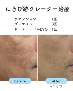 サブシジョンの症例2