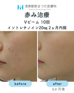 症例1 赤み治療