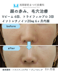 症例3 顔の赤み、毛穴治療