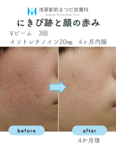 症例4 にきび跡と顔の赤み