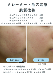 症例6 クレーター・毛穴治療、肌質改善