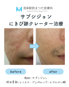 サブシジョンの症例5