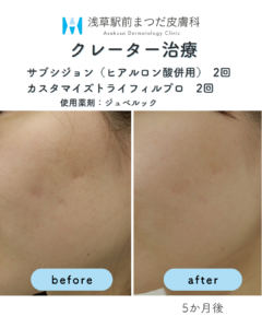 サブシジョンの症例1