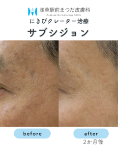 サブシジョンの症例3