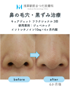 症例2 鼻の毛穴・黒ずみ治療