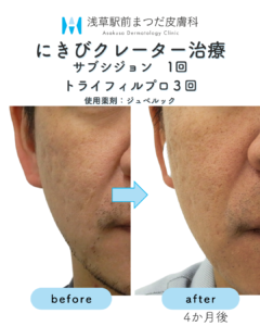 サブシジョンの症例4