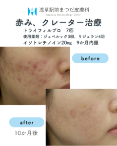 症例7 赤み、クレーター治療