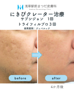 サブシジョンの症例8