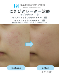 サブシジョンの症例7