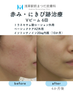 症例8 赤み・にきび跡治療