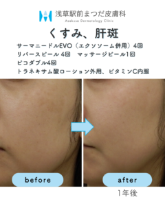 症例4　くすみ、肝班