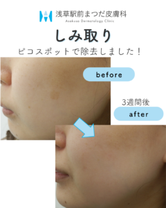 症例5　しみ取り