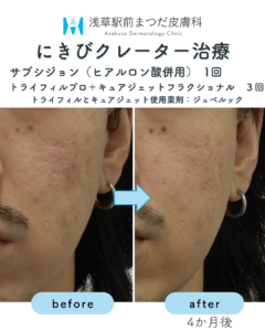 サブシジョンの症例10