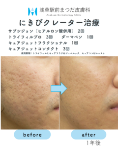 サブシジョンの症例11