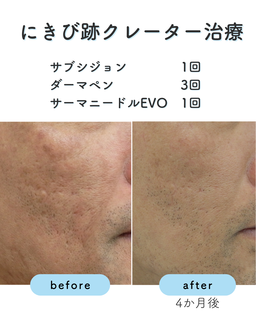 にきび跡クレーター治療