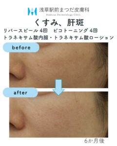 くすみ、肝斑