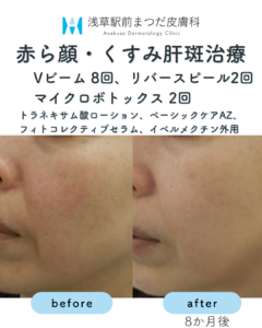赤ら顔・くすみ肝斑治療
