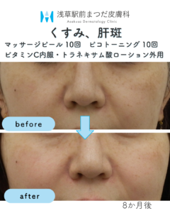 くすみ、肝斑